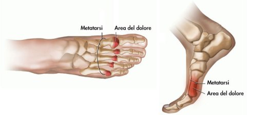 metatarsalgia