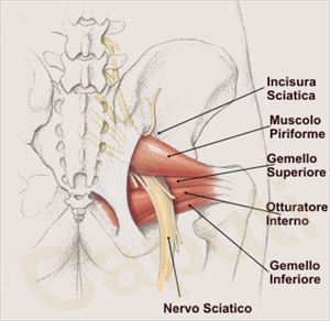 Sindrome del piriforme